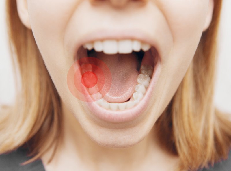 CAVITIES BETWEEN TEETH: CAUSES, SIGNS, AND PREVENTION